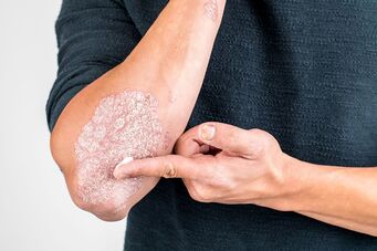 Apply the cream on the skin damaged by psoriasis
