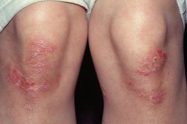 psoriasis of the knees