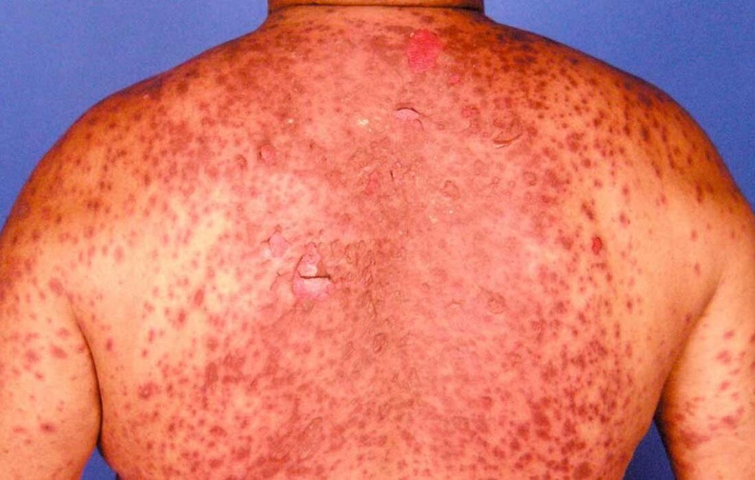 psoriatic erythroderma of the back