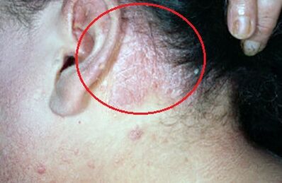 psoriasis of the head photo 2