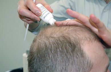 treatment of psoriasis of the scalp