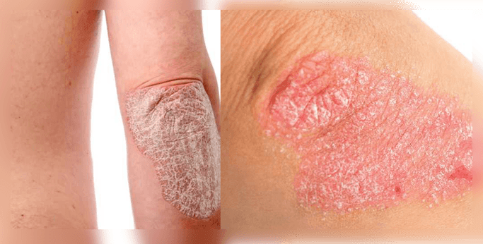 what psoriasis of the skin looks like