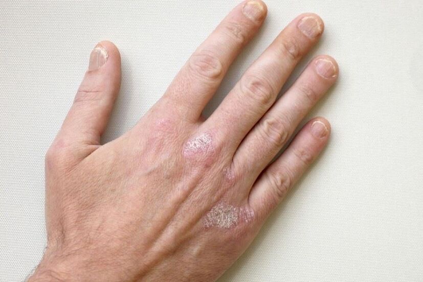 A mandatory symptom of psoriasis are scaly plaques on the skin