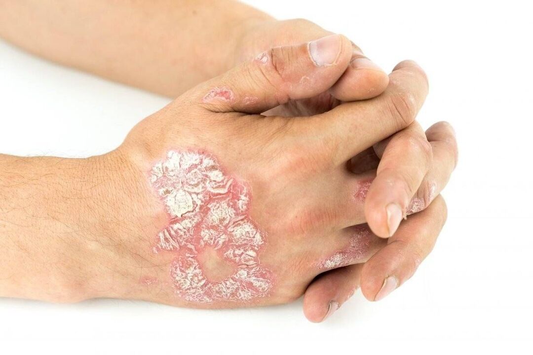 exacerbation of hand psoriasis