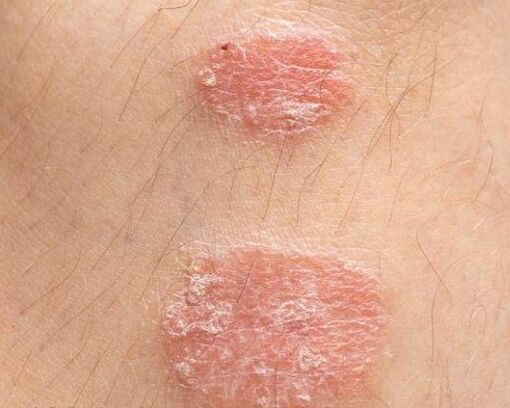 The appearance of psoriatic plaques