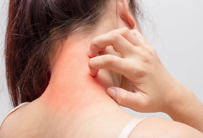 Itching is one of the reasons for psoriasis