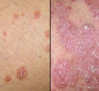 Psoriatic plaques
