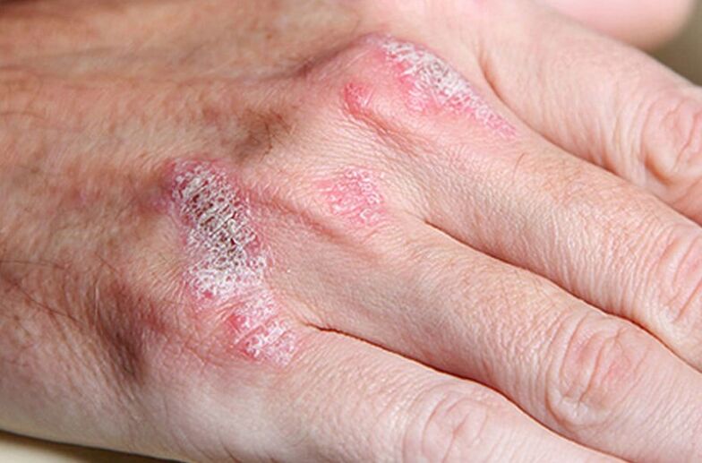 Psoriasis supported by Ladomary
