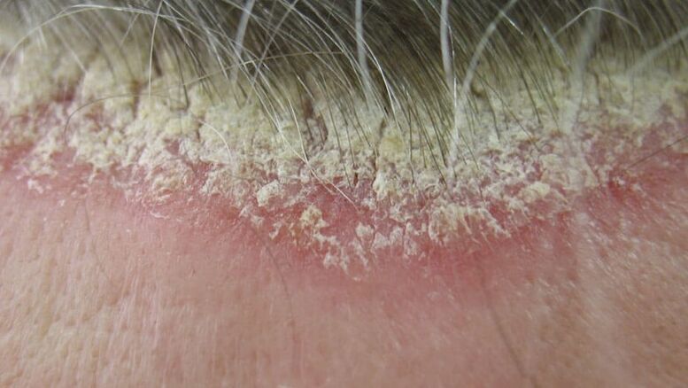 Scalp psoriasis