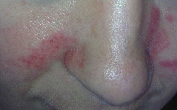 Symptoms of Psoriasis Facial