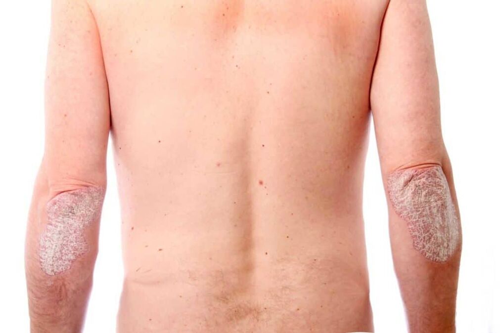 The second stage of psoriasis
