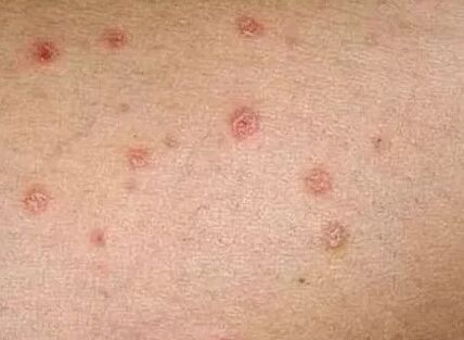 Psoriasis at the initial stage
