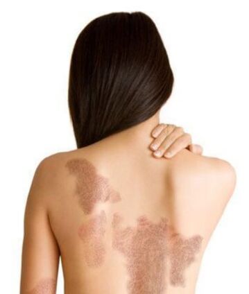 Psoriasis stages depending on the area of ​​the lesion