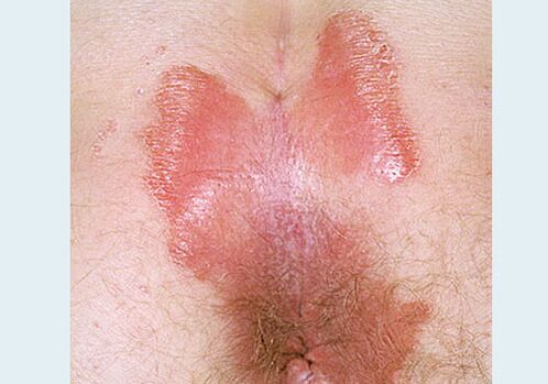 Closing -Psoriasis Posteriasis