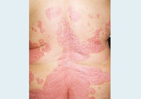 Psoriasis on the back