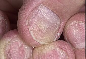 Nail psoriasis