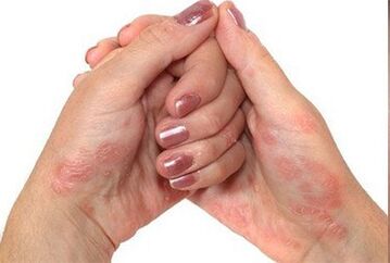 Psoriasis in the hands