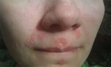 Psoriasis of the face