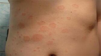 Psoriasis of the stomach