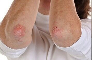Psoriasis on the elbows