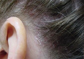 Psoriasis on the head