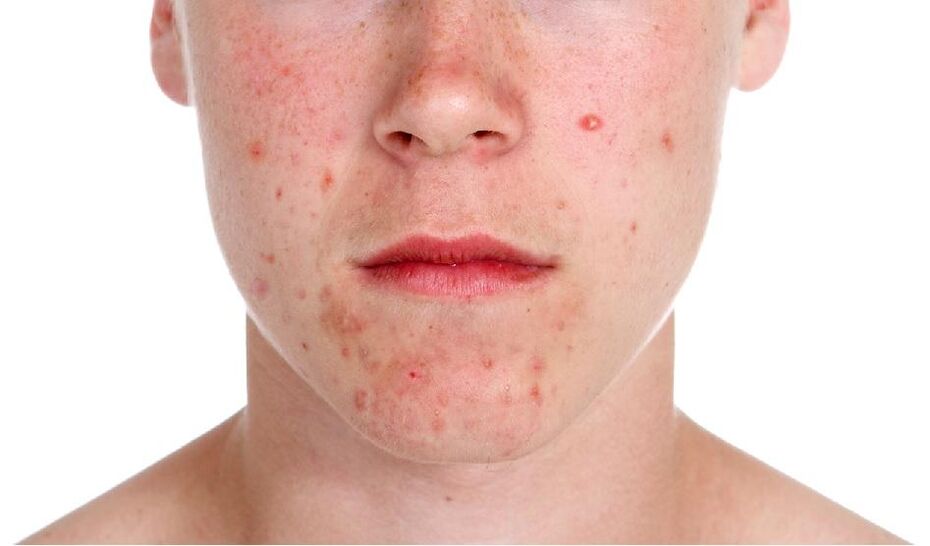 Psoriasis of the face