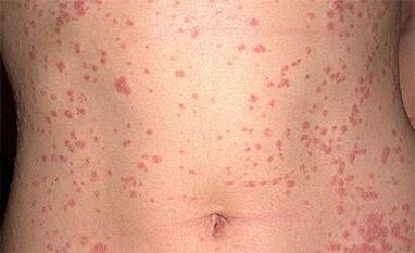 Psoriasis on the body