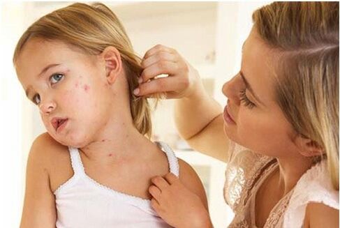 Photo of the initial stage of psoriasis