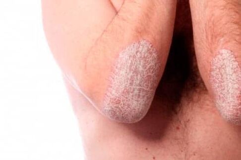 Elbow psoriasis