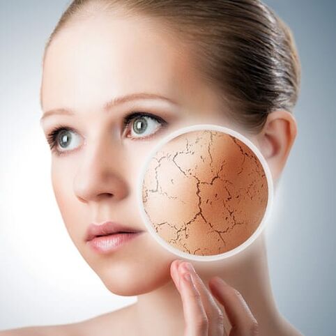 Psoriasis on the face