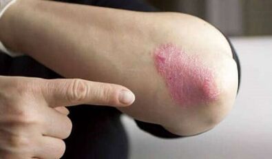 stationary stage of development of psoriasis
