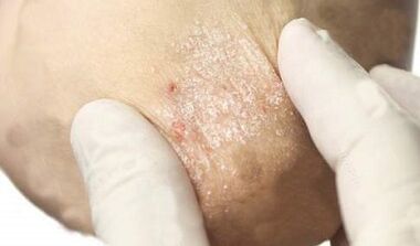 treatment of psoriasis in the remission stage