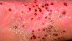 Pustular psoriasis