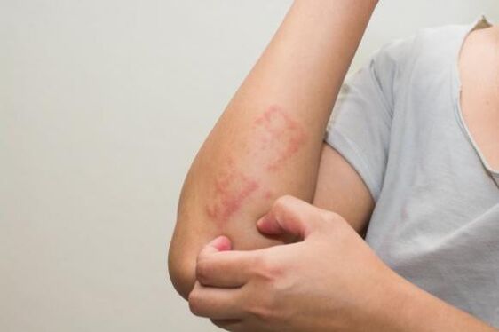 The most methods of treating psoriasis