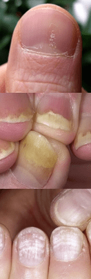 Nail psoriasis - initial stage