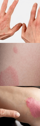 Psoriasis at the initial stage of the hands