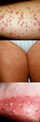 Psoriasis of the feet
