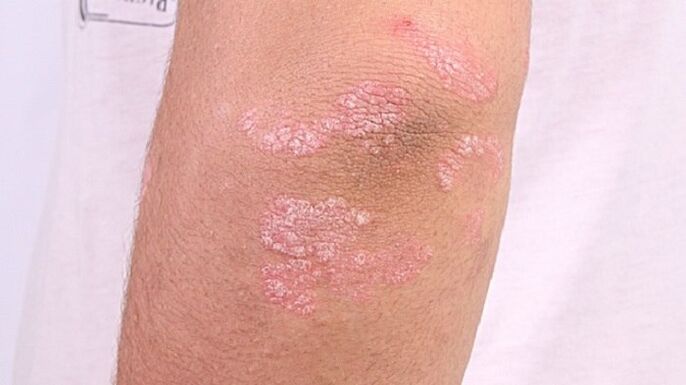 photo of early stage psoriasis
