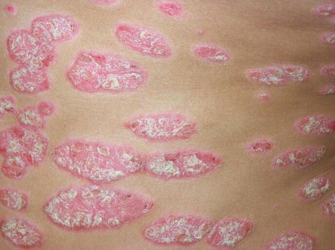 plaque psoriasis