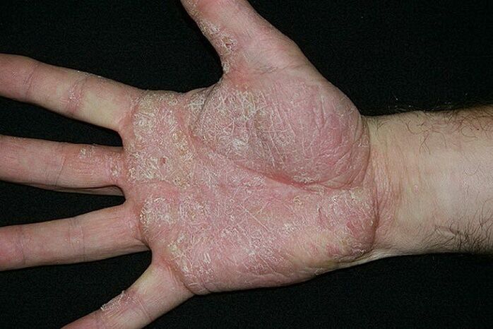 psoriasis of the hands and feet