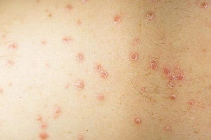 symptoms of punctate psoriasis