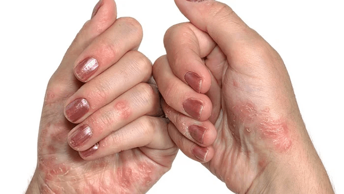 Initial stage of psoriasis