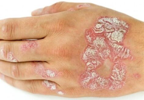 hand psoriasis