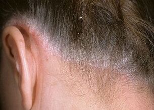 causes of psoriasis of the head