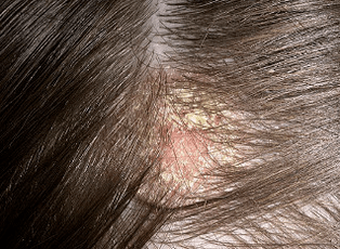the main symptoms of psoriasis of the head