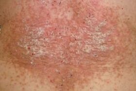 situational stage of psoriasis